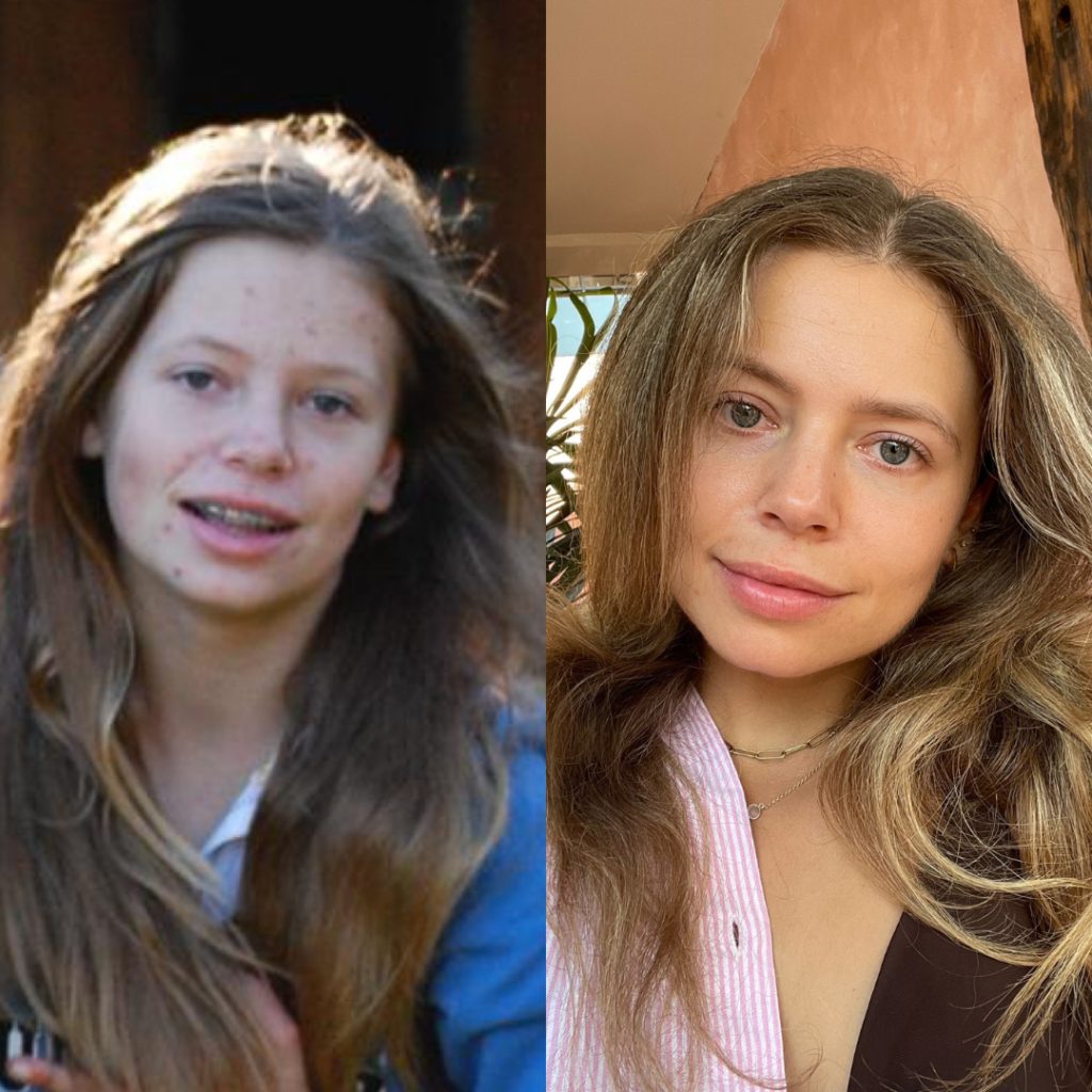 Shelly Acne